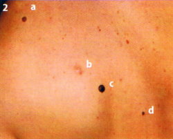 Großaufnahme vom Rücken eines männlichen Patienten mit vier größeren 'Leberflecken' in einer Reihe